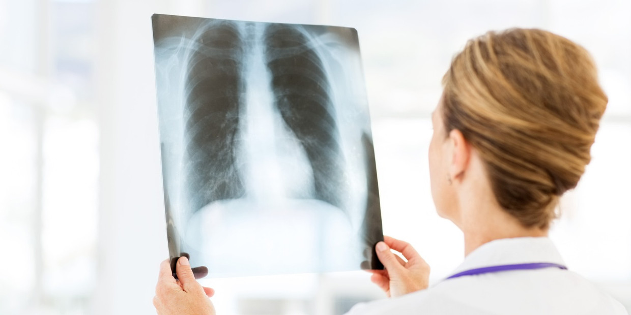 Hoe Lang Duurt Een Gekneusde Rib Hersteltijd En Behandelingstips